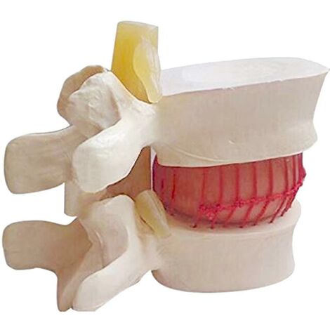1pc Hernie discale lombaire anatomique modèle de colonne vertébrale lombaire couleur blanche Dontodent Dontodent
