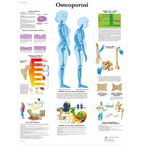 3B Scientific VR4121UU Osteoporosi