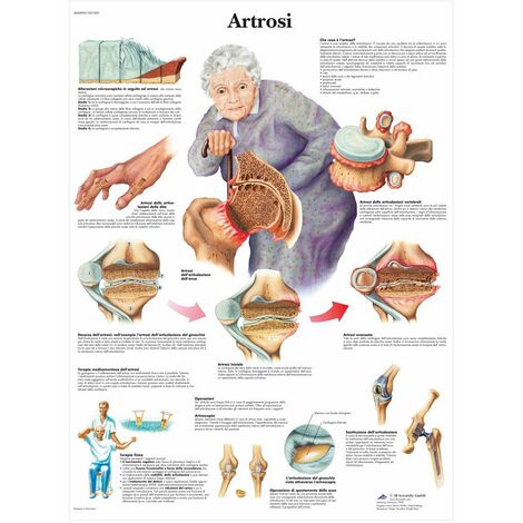3B Scientific VR4123L Artrosi