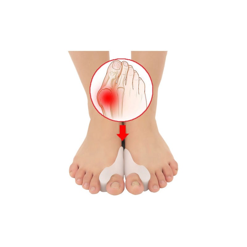 Correcteur d'hallux valgus [6x] silicone amélioré, taille unique - séparateur d'orteils, redresseur, entretoise d'orthèse du pied pour la protection