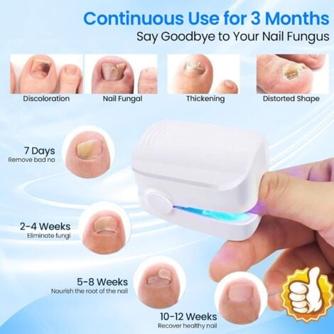 Traitement Laser Mycose Ongles, Mycose Ongles des Pieds Nettoyage et Réparation Ongles, Traitement Champignons Ongles,7 Minutes par Jour - Ne Soyez Plus Gêné