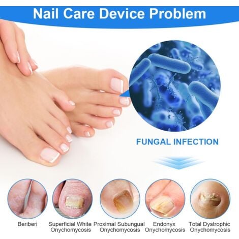 Appareil Traitement Laser Mycose Ongles, Portable Dispositif des Champignons des Ongles, Dispositif de Traitement Laser pour Mycose Ongles des Pieds Nettoyage et Réparation Ongles Traitement