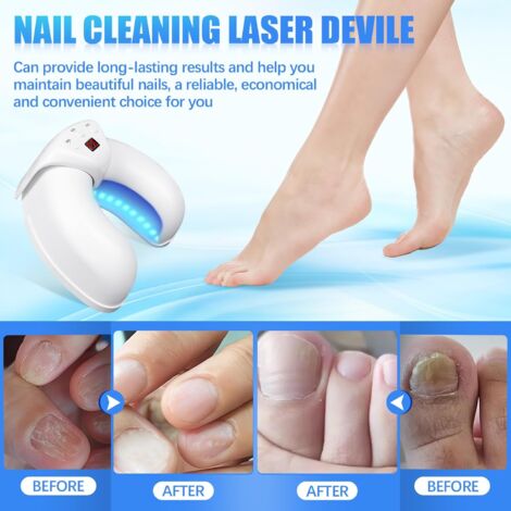 Appareil Traitement Laser Mycose Ongles, Dispositif de Traitement des Champignons des Ongles, Mycose Ongles des Pieds Nettoyage et Réparation Ongles Traitement, 7 Min par Jour Améliorer Fongique