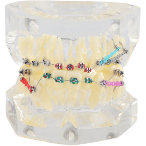 Modèle d'Étude Dentaire Orthodontique avec Chaînette pour Traitement de Malocclusion (1/5)
