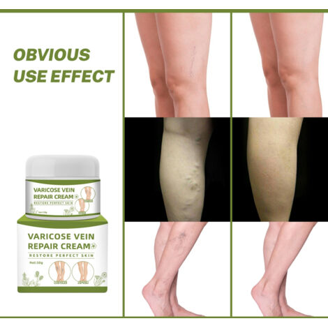 Gel Anti-Varicose pour Améliorer la Circulation Sanguine et Soulager les Jambes Lourdes