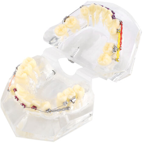 Modèle d'Étude Dentaire Orthodontique avec Chaînette pour Traitement de Malocclusion (1/5)