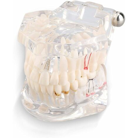 LTS FAFA Modèle de dents dentaires, modèle de dent d'implant dentaire, modèle de dents de démonstration dentaire, adapté aux présentations juridiques des cabinets dentaires et aux programmes des écol