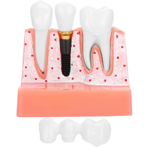 Modèle dentaire pour démonstration d'implant, couronne et bridge