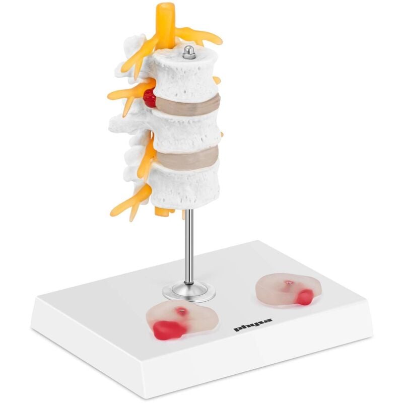 Modello Anatomico Ernia Del Disco Lombare Colorato Con Base Di Sostegno Plastica