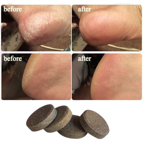 Bain de Pieds Détente au Gingembre - 10 Comprimés Effervescents - Antifongique, Revitalisant et Anti-Fatigue - Soin Podologique Complet (1/2)