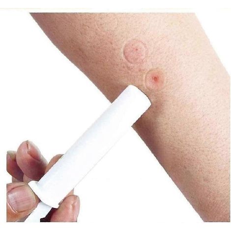 Kit de premiers secours pour piqûres de moustiques et d'abeilles (2 pièces) avec ventouse, idéal pour la randonnée, le trekking et le camping. (1/5)