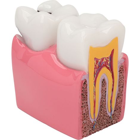 Modèle de Carie Dentaire 6X pour Démonstration Dentaire et Formation en Odontologie (1/5)