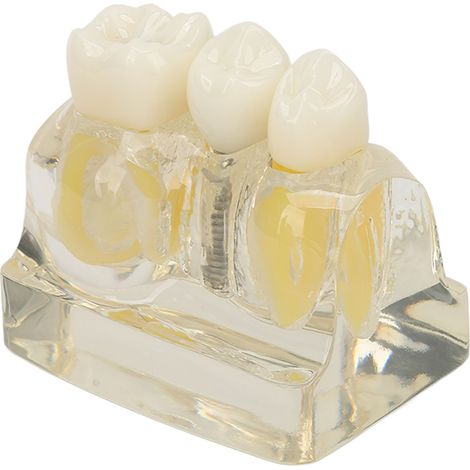 Modèle dentaire transparent pour implants dentaires, démonstration pédagogique et recherche dentaire (1/5)