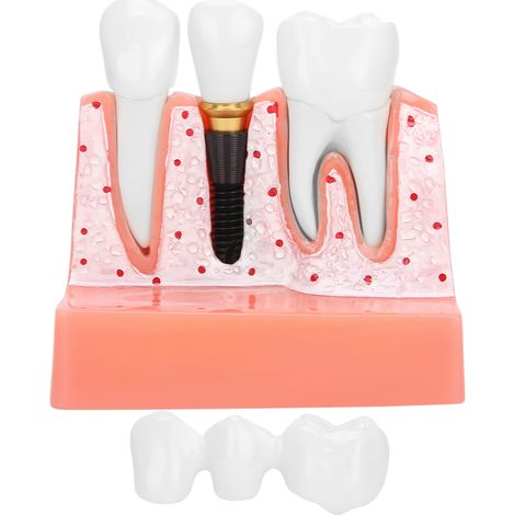 Modèle dentaire pour démonstration d'implant, couronne et bridge (1/5)