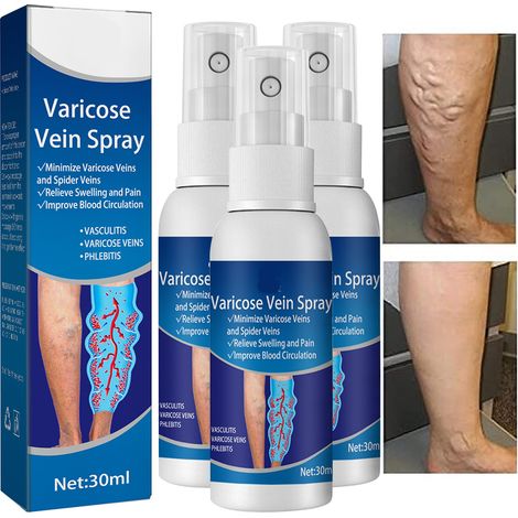 Spray Veines Variqueuses - Formule Naturelle 30ml - Soutien Circulation Sanguine - Usage Quotidien Jambes