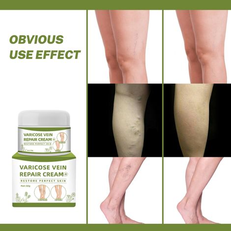 Gel Anti-Varicose pour Améliorer la Circulation Sanguine et Soulager les Jambes Lourdes (1/4)
