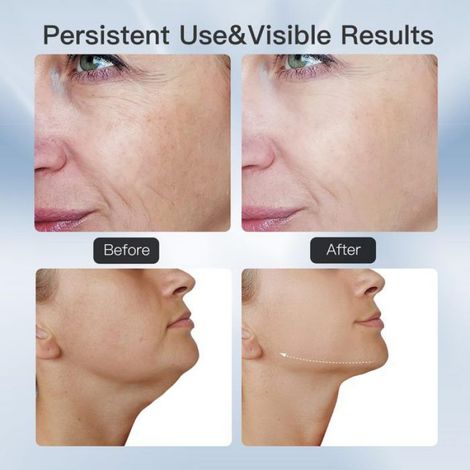 Appareil Anti-Rides Visage, Lifting Visage et Double Menton avec 3 Modes LED, Chauffage à 45℃ pour Raffermissement du Visage, Massage Facial (1/5)