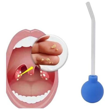 Outil D’élimination Des Calculs Amygdaliens Pompe D’aspiration En PVC Tube D’aspiration Gorge Anti-Mauvaise Haleine Nettoyant Buccal Ergonomique Léger Portable Accessoire De Soin Bucco-Denta (1/4)