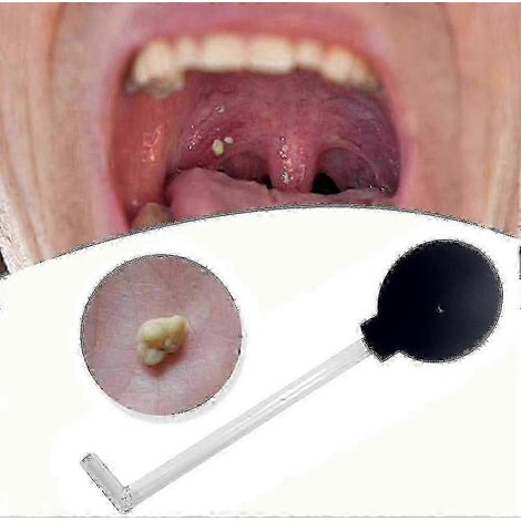 Aspirateur pour ablation des amygdales, kit d'extraction des amygdales, outil d'aspiration des amygdales, aspirateur buccal pour le nettoyage de la bouche (1/4)