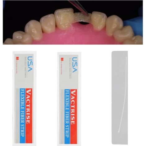 piece of dental material, glass splint, fixation band for loose teeth, light-cured adhesive (1/5)