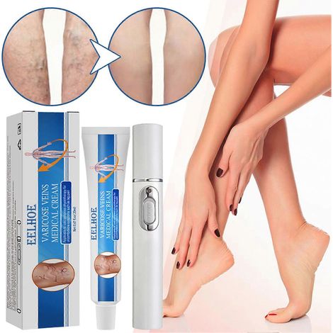 Kit de traitement des varices par lumière bleue Veins Health, traitement des varices des jambes - 1 stylo laser + 1 crème