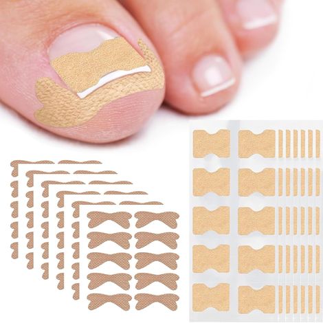 110 Pièces Ongle Incarné Kit de Traitement Complet,Correcteur d'Ongles avec Autocollants,Bandes de Coton et Pansements,Soin de Pédicurie pour Orteils
