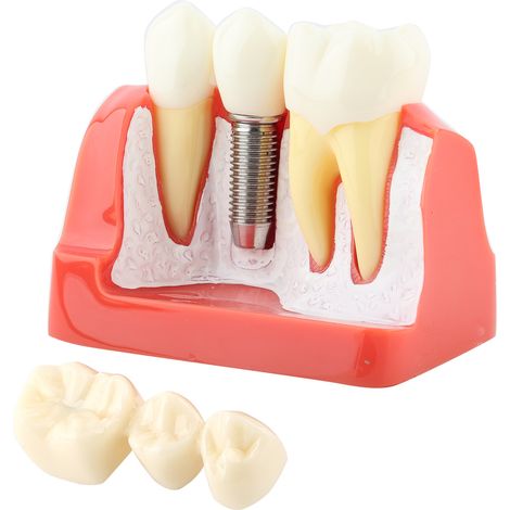 Modèle dentaire en résine pour démonstration, 1 pièce, implant, analyse couronne et bridge, outil professionnel pour dentiste (1/5)