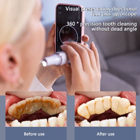 Nettoyeur de tartre ultrasonique, 3 modes réglables, 4 embouts visibles, kit de soins dentaires domestique pour éliminer le tartre et blanchir les dents (1/5)