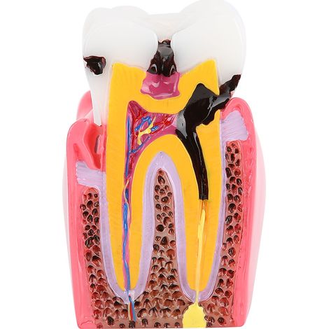 Modèles d'étude de caries dentaires pour éducation anatomique, formation dentaire - Ensemble pédagogique (1/5)