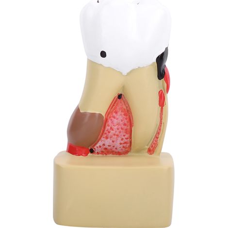 1pc Modèle Dentaire Pédagogique pour l'Étude des Caries et Pathologies Bucco-dentaires (1/5)