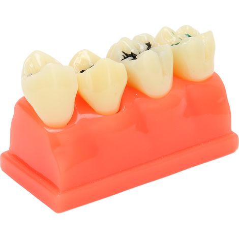 Modèle de carie dentaire en résine, 4 dents éducatives pour soins bucco-dentaires, exposition de dents cariées pour cabinet dentaire (1/5)