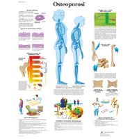 3B Scientific VR4121UU Osteoporosi
